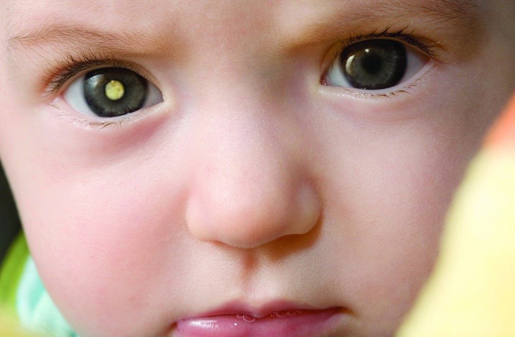 Retinoblastoma