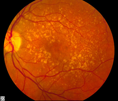 Degeneración macular