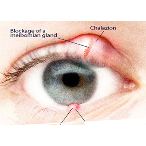 chalazion