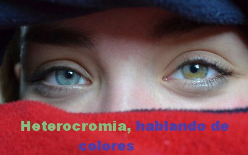 heterocromia