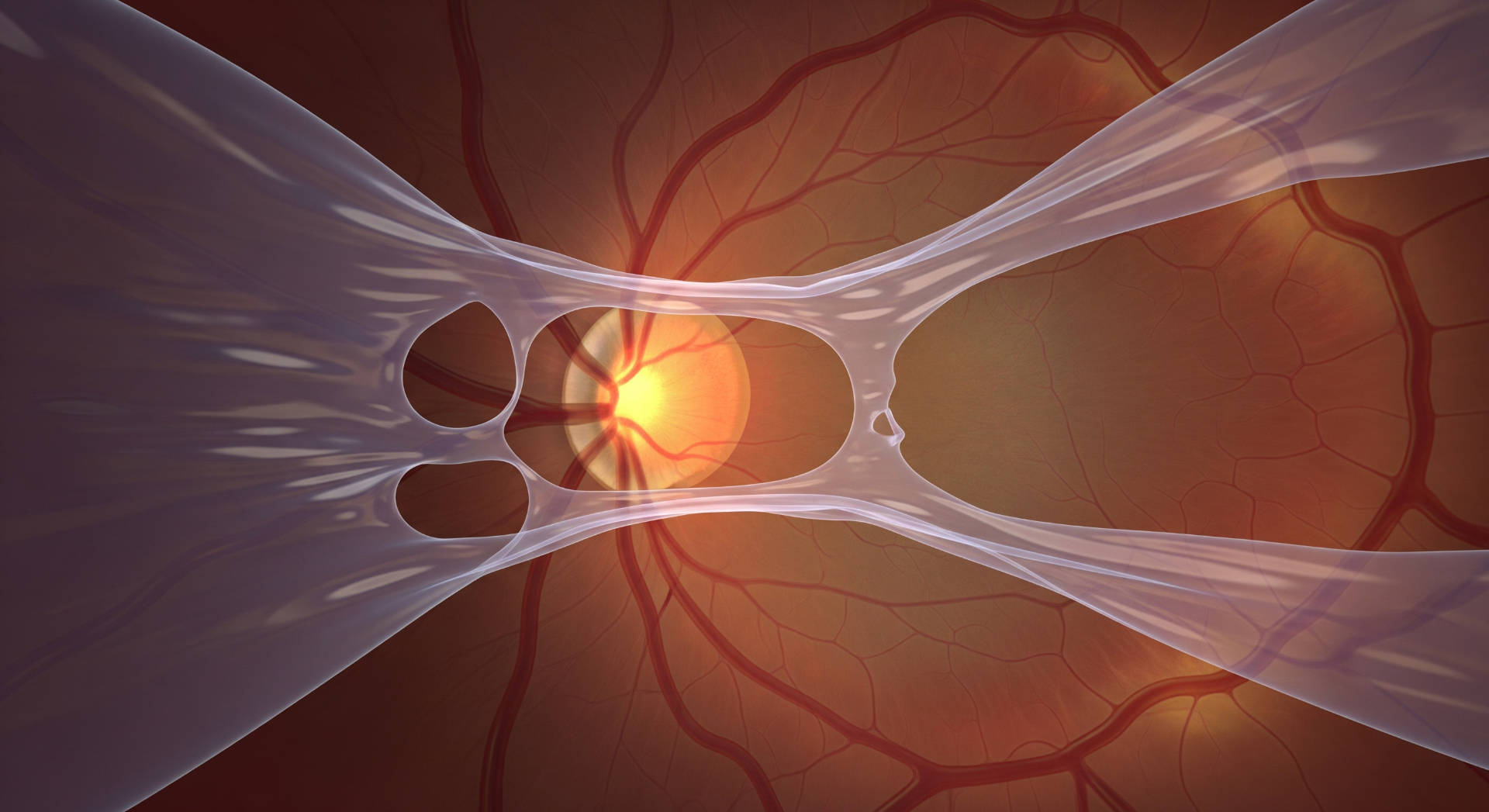 desprendimiento de retina